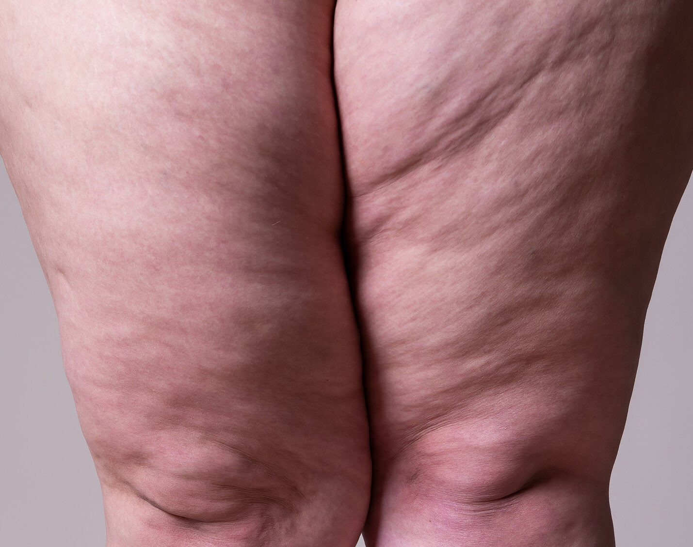 Lipedema afeta mais que a beleza!