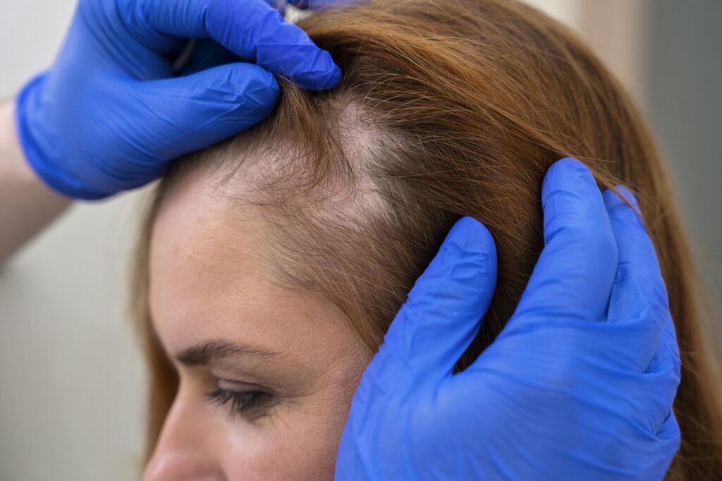 Um cronograma capilar ajuda nos cuidados do cabelo de quem sofre com alopecia