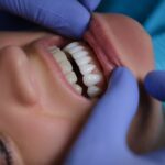 A nova técnica de lentes de contato dental é utilizada com desgaste mínimo dos dentes, uma novidade no mercado odontológico