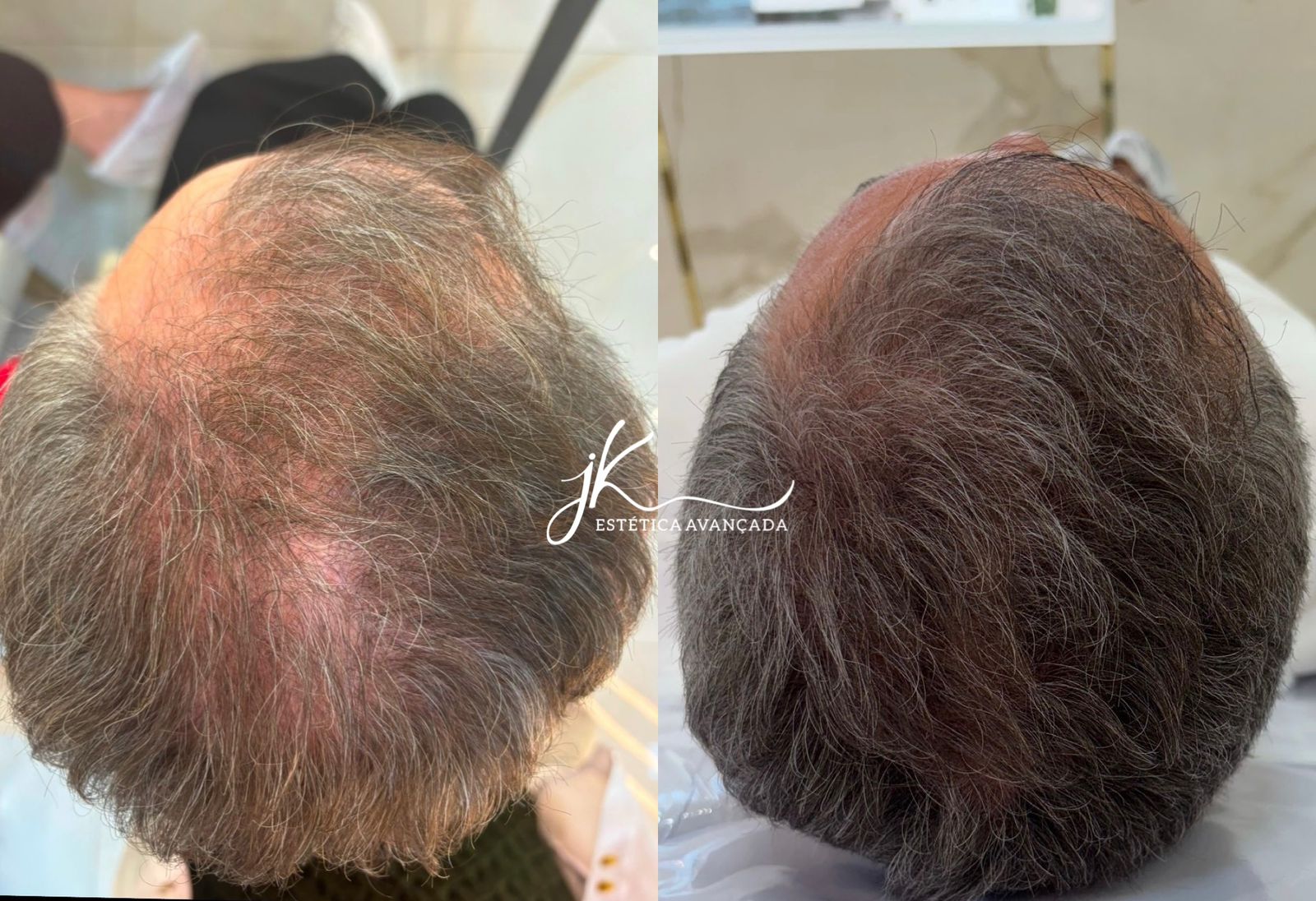 Alopecia androgenética: entenda a condição de Xuxa