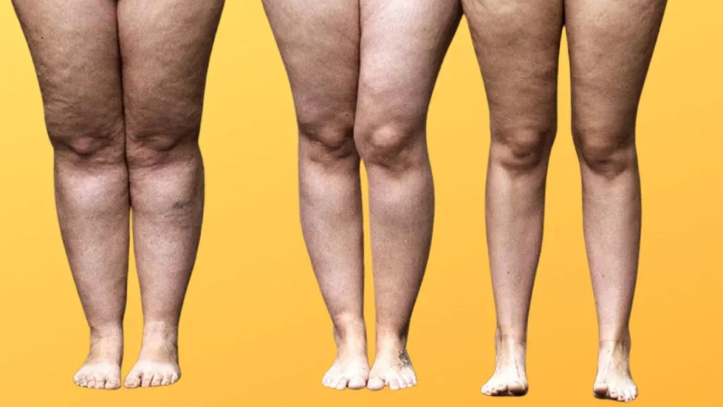 Embora frequentemente confundido com obesidade ou celulite, o lipedema é uma doença distinta, e sua visibilidade aumentou nas últimas décadas