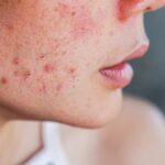A acne da mulher adulta, que pode afetar a autoestima e gerar insegurança em muitas mulheres, pode ser tratada de diversas formas