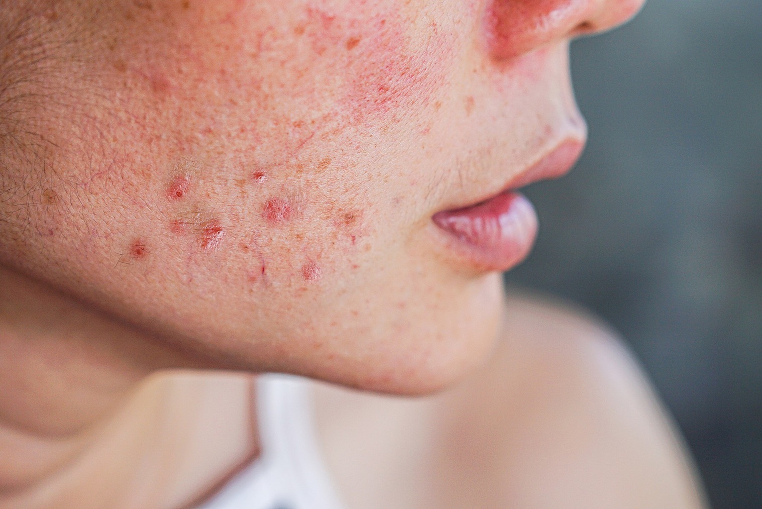 Acne da mulher adulta: Especialista explica o que é e como tratá-la