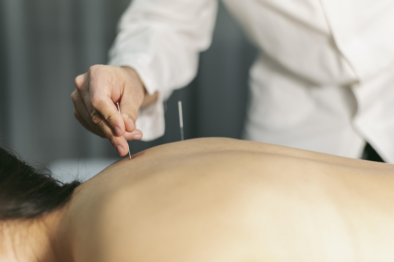 Acupuntura: aliada no tratamento da fibromialgia