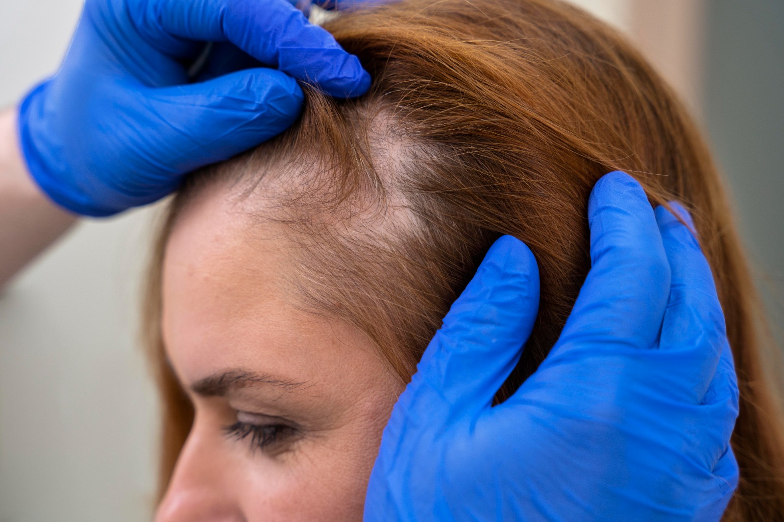 Alopecia: quando a queda de cabelo se torna um sinal de alerta