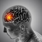 Aneurisma cerebral é hereditário? Entenda os fatores de risco