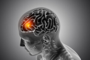 Aneurisma cerebral é hereditário? Entenda os fatores de risco