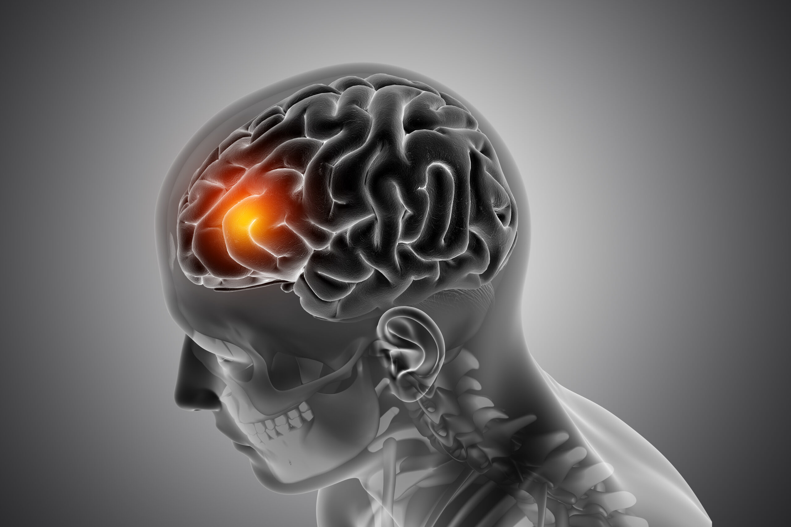 Aneurisma cerebral é hereditário? Entenda os fatores de risco