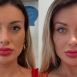 Procedimento nos olhos feito por Andressa Urach pode causar cegueira