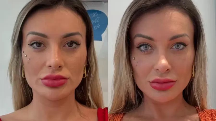Procedimento nos olhos feito por Andressa Urach pode causar cegueira