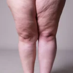 A prevalência estimada de lipedema na população feminina entre 18 e 69 anos é de 12,3%, o que representa cerca de 8 milhões de brasileiras