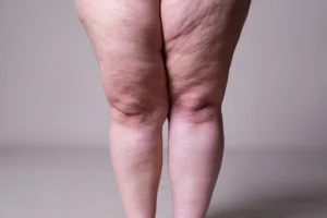 A prevalência estimada de lipedema na população feminina entre 18 e 69 anos é de 12,3%, o que representa cerca de 8 milhões de brasileiras