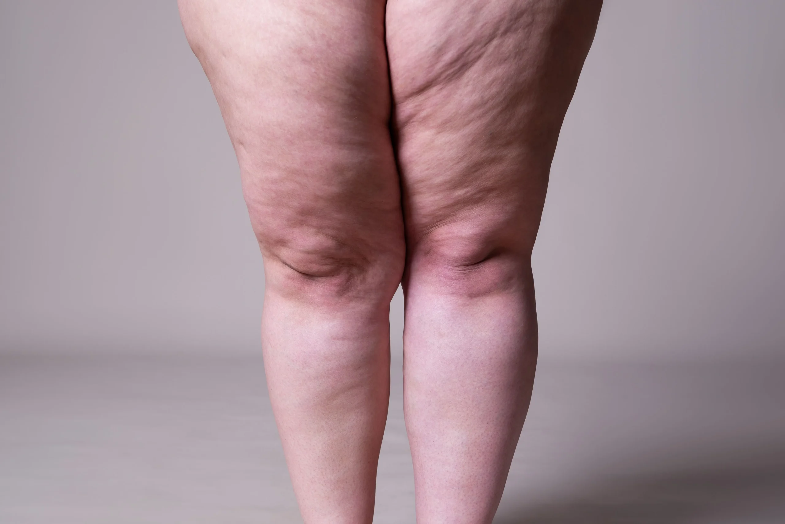 Junho Roxo: 8 milhões de brasileiras podem ter lipedema