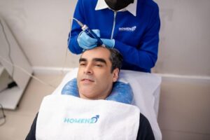 Transplante capilar: mitos e verdades sobre o procedimento