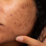 O melasma também merece cuidados na estação fria. E a dieta pode ser uma grande aliada — ou inimiga silenciosa