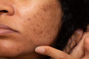 O melasma pode piorar no inverno?