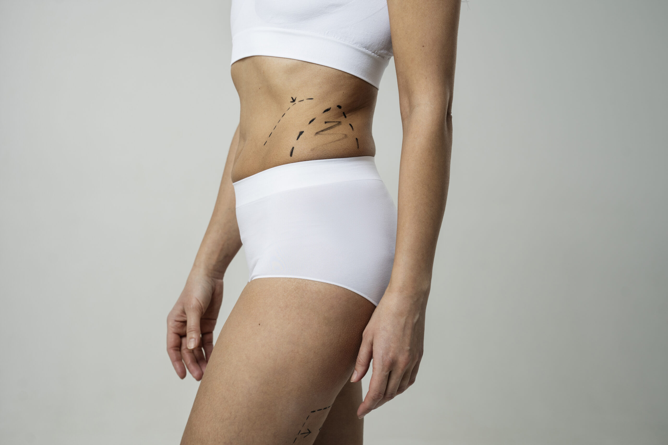 Lipo HD e tecnologias de contorno: o futuro das cirurgias plásticas