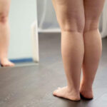 Lipedema pode causar dor no joelho? Entenda os impactos na mobilidade