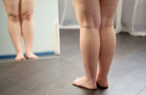 Lipedema pode causar dor no joelho? Entenda os impactos na mobilidade