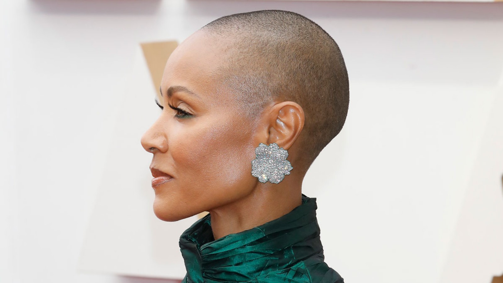 Alopecia areata: entenda a condição que afeta famosas