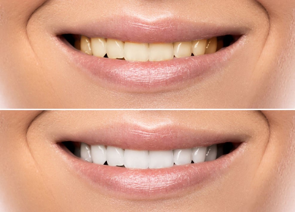 Clareamento dental caseiro sem supervisão pode trazer riscos