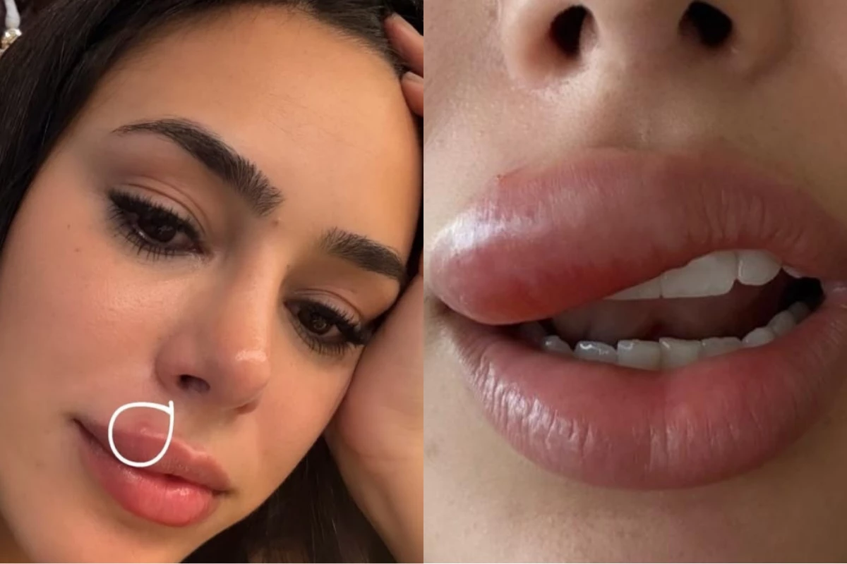 Celulite facial: entenda o caso de Bruna Biancardi