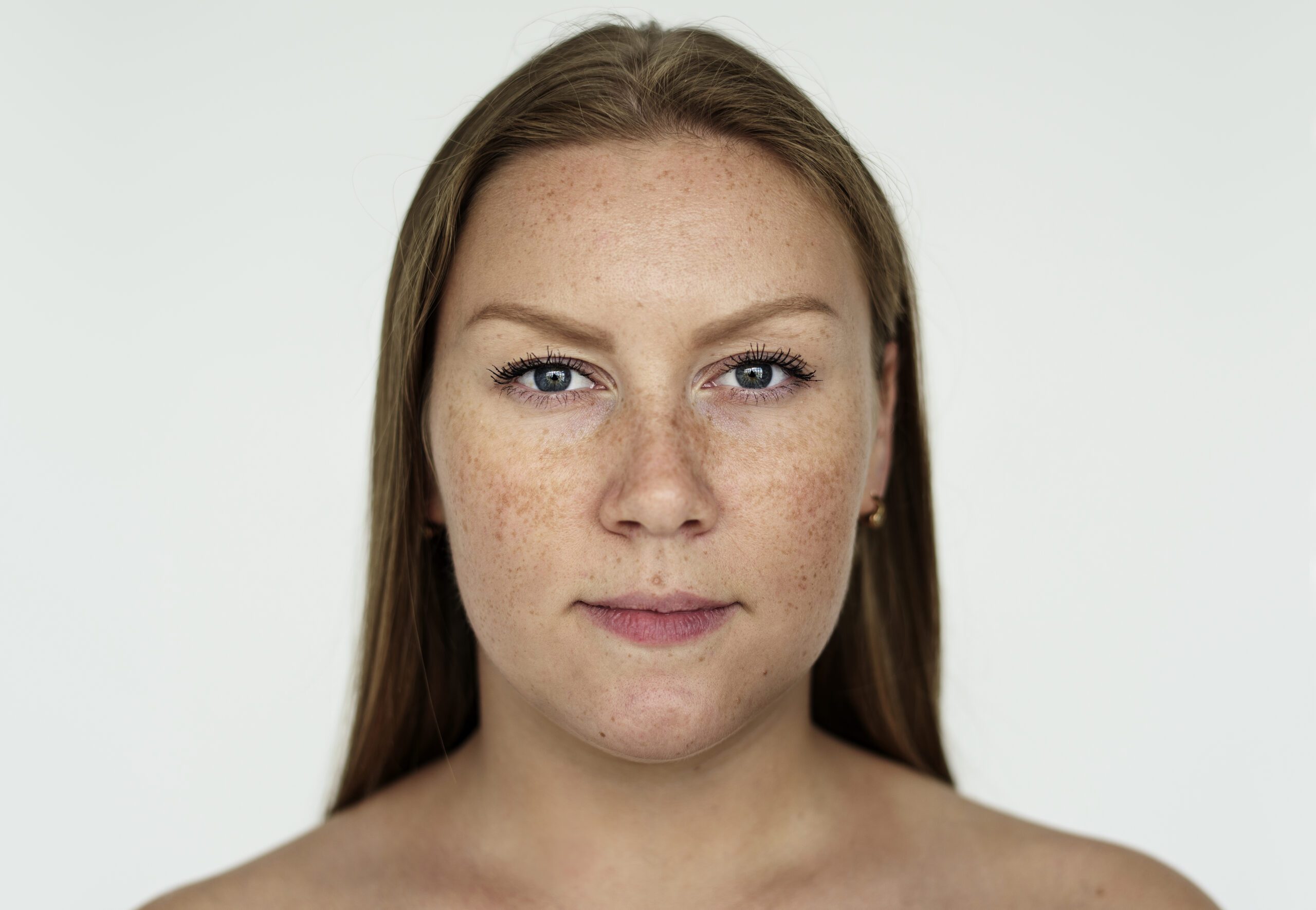 Dermatologista alerta sobre truques caseiros para tratar melasma