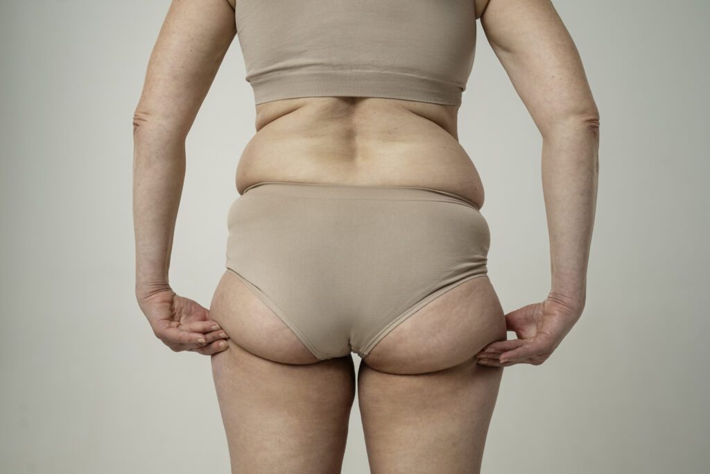 Dor, inchaço e gordura desproporcional? Pode ser lipedema!