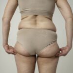 Dor, inchaço e gordura desproporcional? Pode ser lipedema!