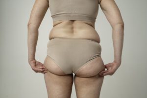 Dor, inchaço e gordura desproporcional? Pode ser lipedema!