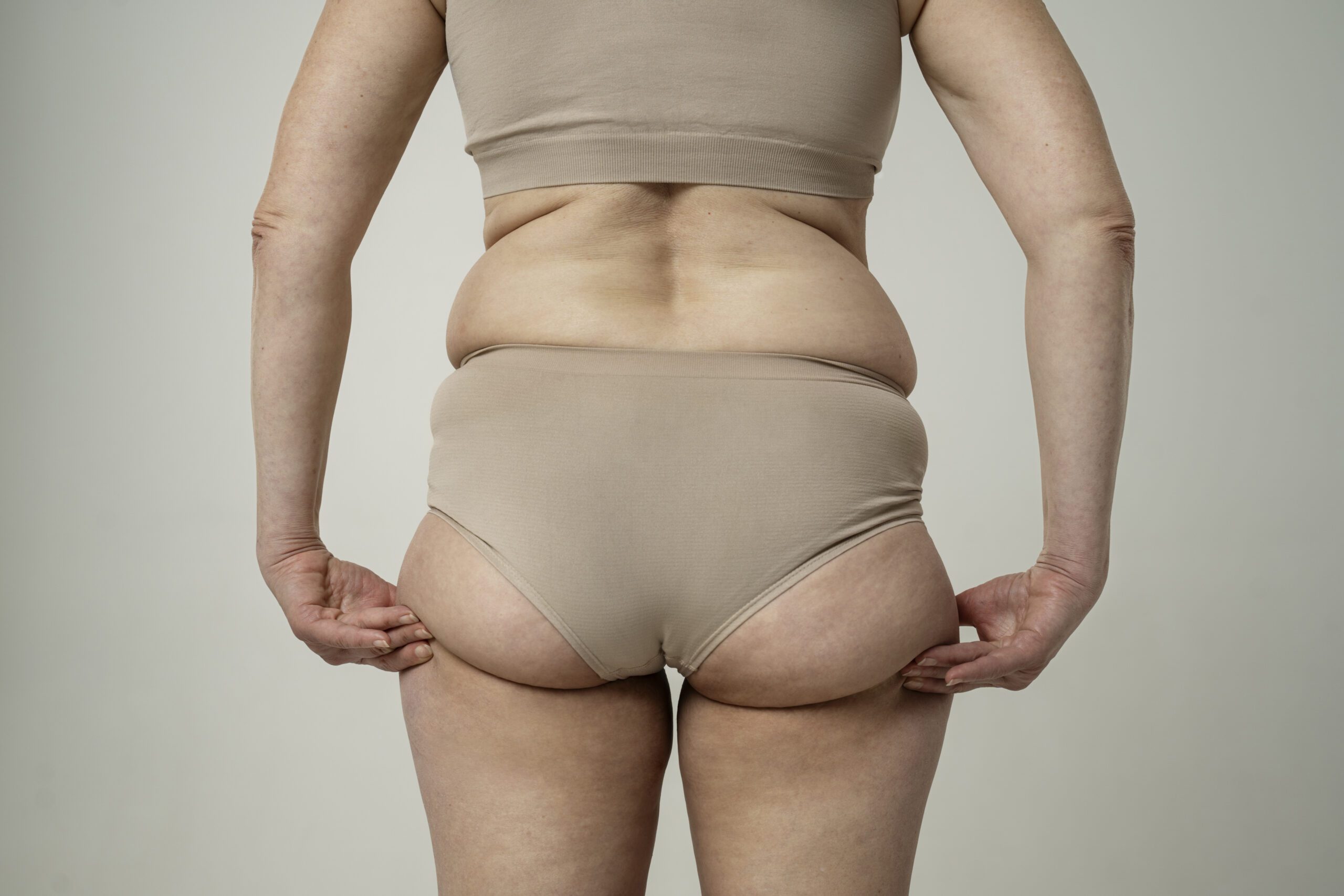 Dor, inchaço e gordura desproporcional? Pode ser lipedema!