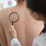 A ultrassonografia de alta frequência e a análise genômica ajudam na detecção precoce do câncer de pele