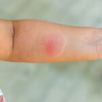 O que fazer em caso de picada de aranha em crianças?