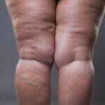 Saiba quais exercícios são essenciais no tratamento do lipedema