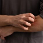 Picadas de inseto: redobre a atenção no verão