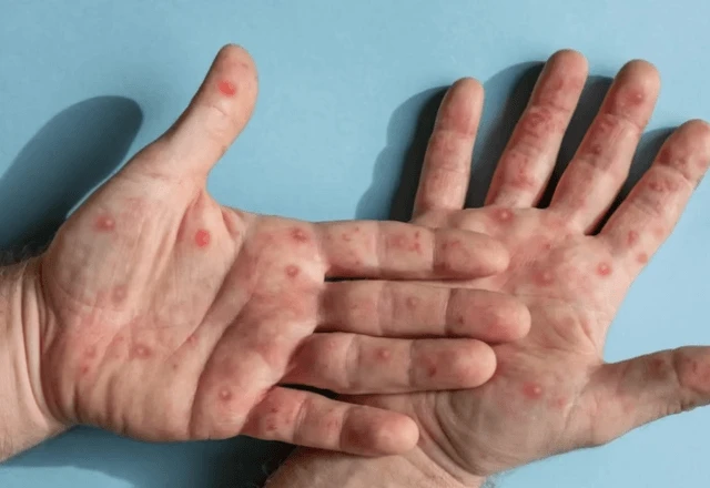 Surto de mpox: saiba como identificar os sintomas