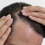 Entradas no cabelo: quando é sinal de calvície e o que fazer