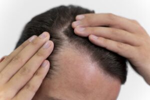 Entradas no cabelo: quando é sinal de calvície e o que fazer