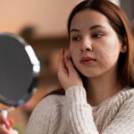 Acne adulta ou rosácea? Saiba a diferença!