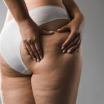 É lipedema ou retenção de líquido? Tire essa e outras dúvidas!