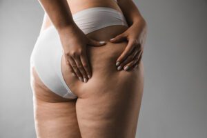 É lipedema ou retenção de líquido? Tire essa e outras dúvidas!