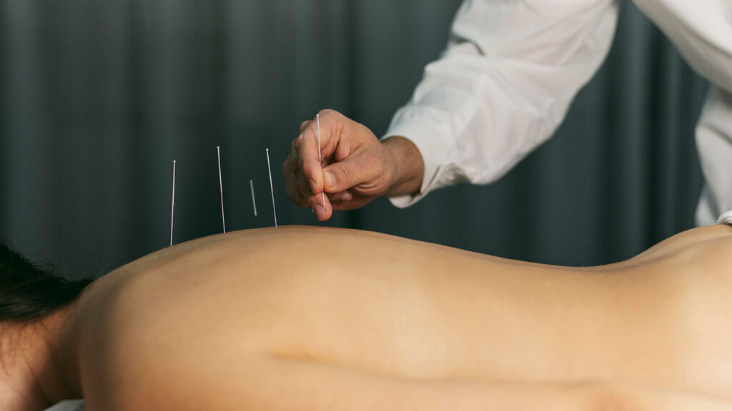 A acupuntura é uma técnica promissora que ajuda a parar de fumar