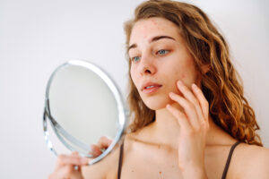 Skincare para pele acneica: 7 mitos e verdades