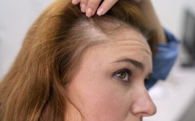 A queda de cabelo durante a menopausa é uma das questões que mais assusta as mulheres