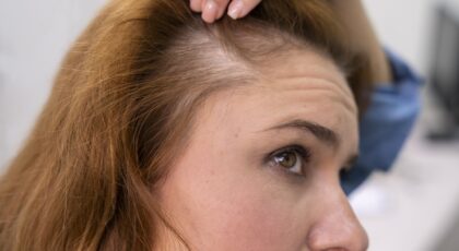 A queda de cabelo durante a menopausa é uma das questões que mais assusta as mulheres